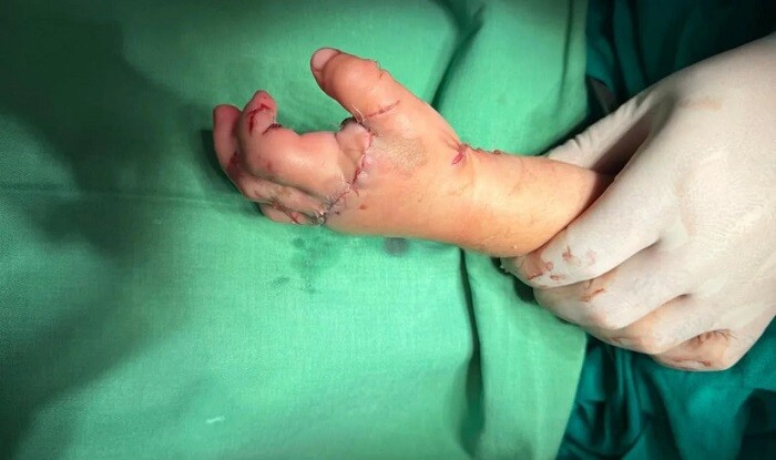 3 yaşlı uşağın ət maşınında qalan əli bərpa edildi - Foto
