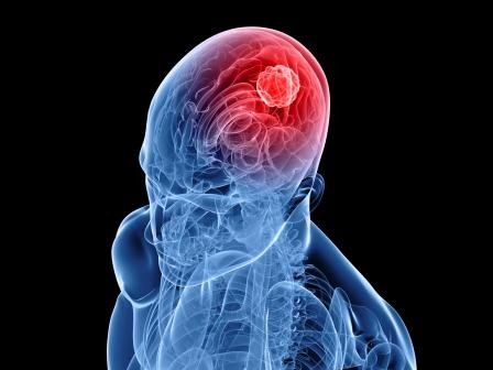 Brain tumor survivors have these problems